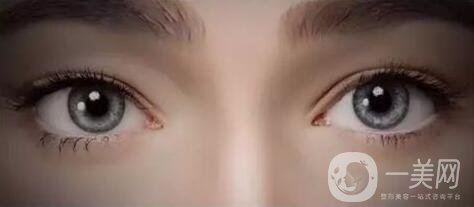 開眼角手術(shù)價(jià)格是多少？