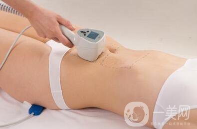 360度環(huán)形溶脂塑形*果好嗎