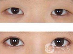 開眼角眼睛變化大嗎？