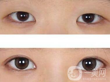 開眼角眼睛變化大嗎？