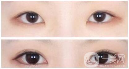 什么是開眼角手術(shù) 術(shù)后如何護理 4