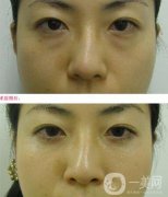 電波拉皮去眼袋果怎么樣？