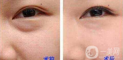 電波拉皮去眼袋*果怎么樣？