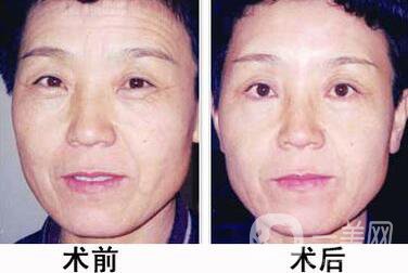 電波拉皮的功*有哪些