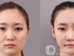 顴骨肉怎么消？怎么縮小顴骨？