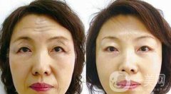 成都做個拉皮多少錢