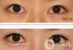 廣州開眼角的費(fèi)用是多少