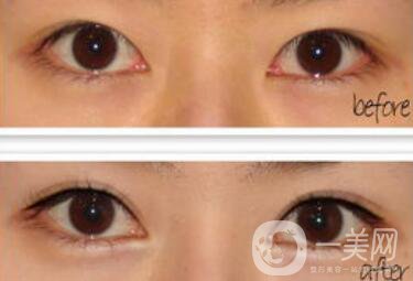 廣州開眼角的費用是多少