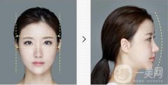 降低顴骨的方法有哪些?術(shù)后怎么護(hù)理?