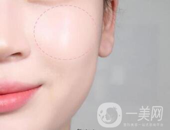 北京自體脂肪豐蘋果肌手術一般多少錢