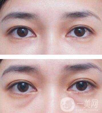 廣東自體脂肪填充淚溝多少錢？