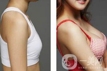 上海假體隆胸的價(jià)格高嗎？要多少錢(qián)
