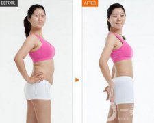 激光溶脂減肥術(shù)后還會反彈嗎