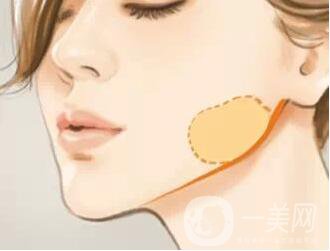 去頰脂墊瘦臉多少錢？