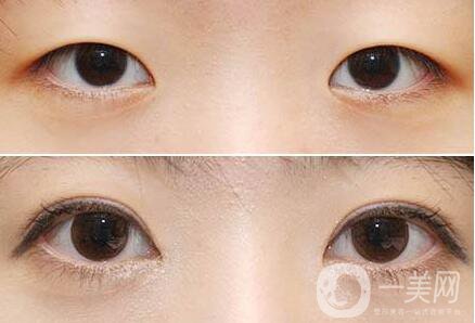 開眼角*果,開眼角注意事項(xiàng)