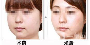 光纖溶脂好不好？價(jià)格是多少