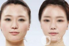 面部光纖溶脂好嗎？?jī)r(jià)格是多少