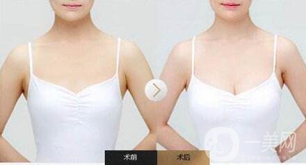 隆胸后怎么護(hù)理？術(shù)前怎么準(zhǔn)備？