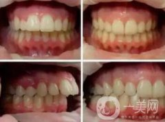 上海天包地牙齒矯正費(fèi)用是多少