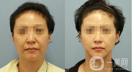 埋線拉皮用的什么線 術后要注意些什么