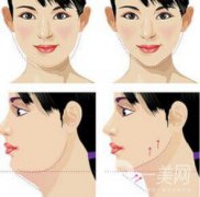 怎么去掉雙下巴？溶脂去雙下巴怎么樣