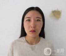 全開雙眼皮和開眼角案例分享，變美就是這么簡單！