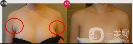 副乳祛除價(jià)格,副乳祛除術(shù)后護(hù)理