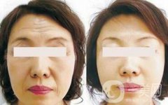 電波拉皮果怎么樣呢？?jī)r(jià)格高嗎