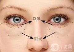 深圳臥蠶整形價(jià)格是多少？