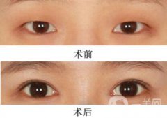 三點定位割雙眼皮多久恢復(fù)