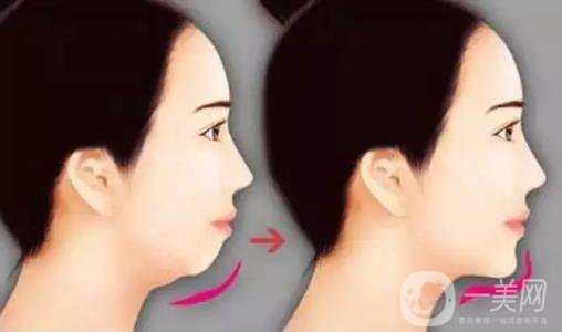 膨體墊下巴有沒(méi)有后遺癥？有些什么后遺癥