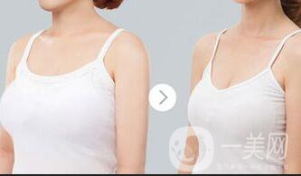 上?？s乳手術(shù)多少錢,縮乳手術(shù)多少錢