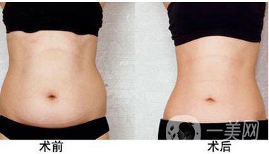成都水動力溶脂減肥價(jià)格介紹一覽