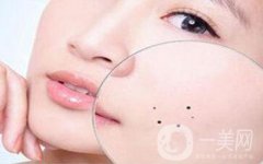 激光祛痣術(shù)后會(huì)留疤嗎