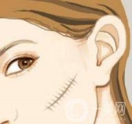 激光祛疤果怎么樣？有什么優(yōu)勢(shì)