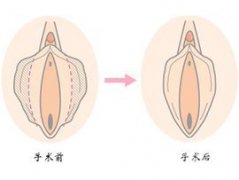 陰唇整形不良后果有哪些？