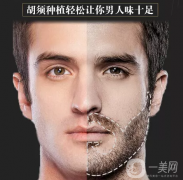 胡須種植注意事項(xiàng)有哪些？
