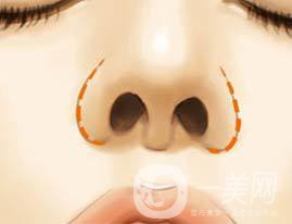 鼻翼縮小手術(shù)價(jià)錢(qián) 