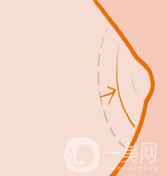 乳暈縮小整形手術(shù)價格是多少呢?