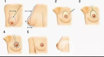 乳頭整形價格,乳頭整形