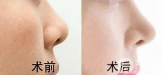 隆鼻價(jià)格