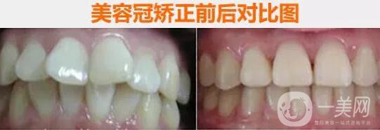 美容冠矯正