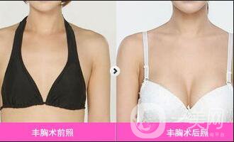 乳房再造整形手術(shù)價(jià)格