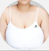 巨乳縮小術(shù)貴嗎？巨乳縮小多少錢？