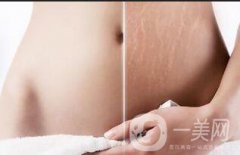 去妊娠紋價(jià)格是多少呢?