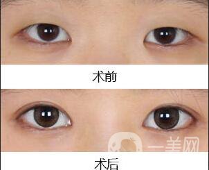 雙眼皮,開眼角,雙眼皮開眼角手術(shù)費用