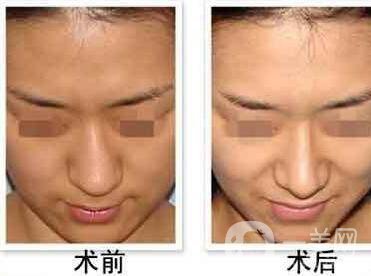 歪鼻矯正手術(shù)多久恢復(fù)