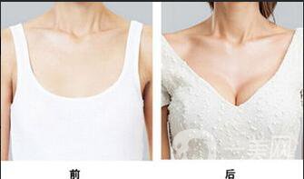 抽脂隆胸多少錢