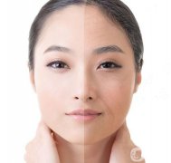 射頻和電波拉皮信息介紹？
