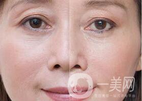 拉皮手術(shù)*果